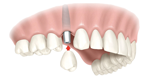 Single Dental Implants Pittsburgh