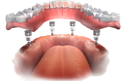 Implant Overdentures Pittsburgh